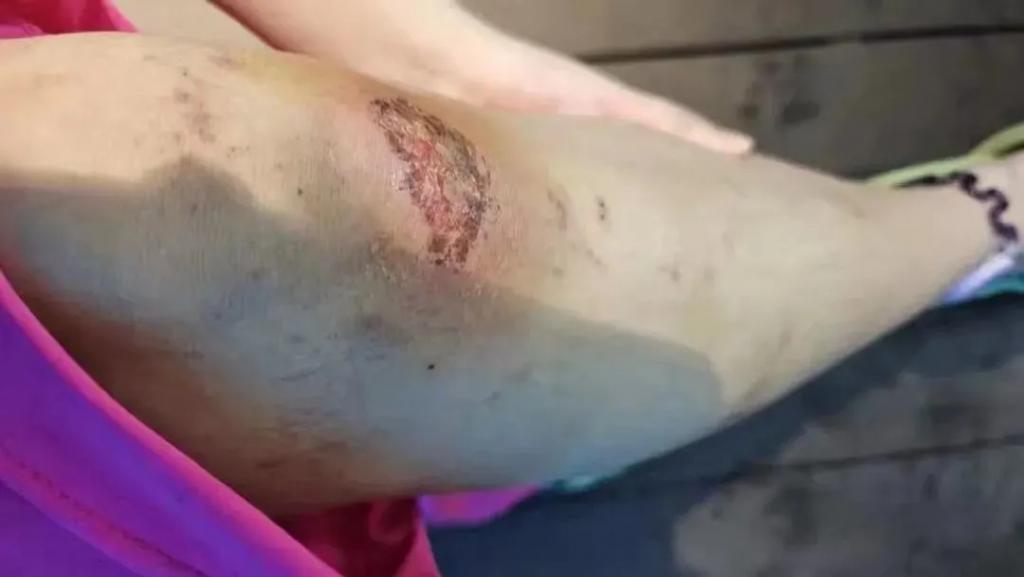 “美人鱼	”女孩溺水进了ICU，危险的青春饭  第10张